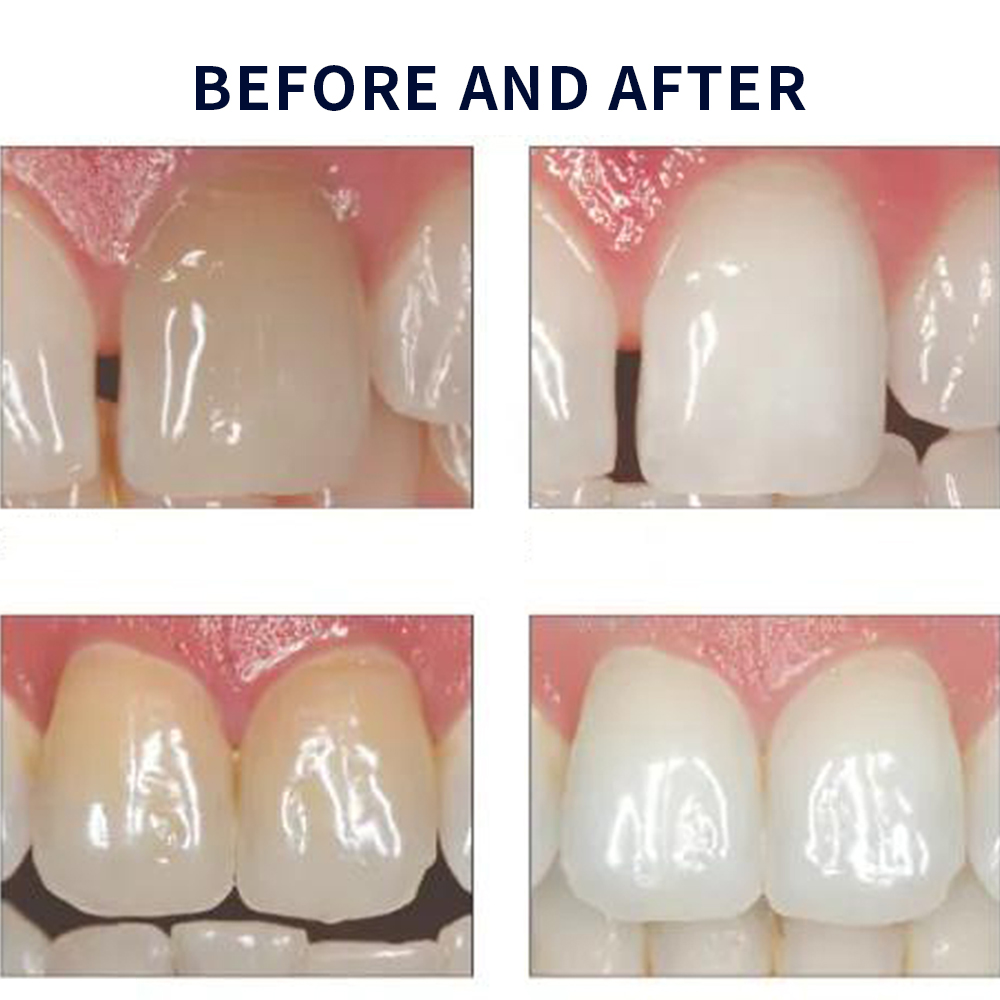 Opalescence Whitening 20% PF 2 - đánh giá và giá Teeth Whitening Kit At Home