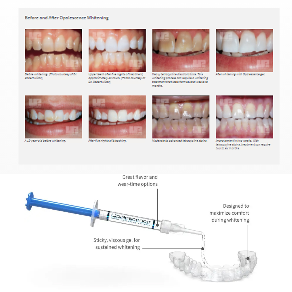 Opalescence Whitening 20% PF 2 - đánh giá và giá Teeth Whitening Kit At Home