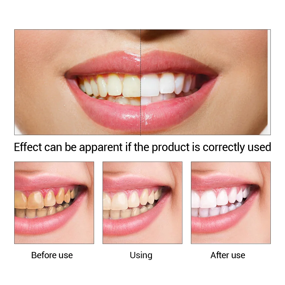 FTEENPLY Làm Trắng Răng Tinh C - đánh giá và giá Teeth Whitening Diy
