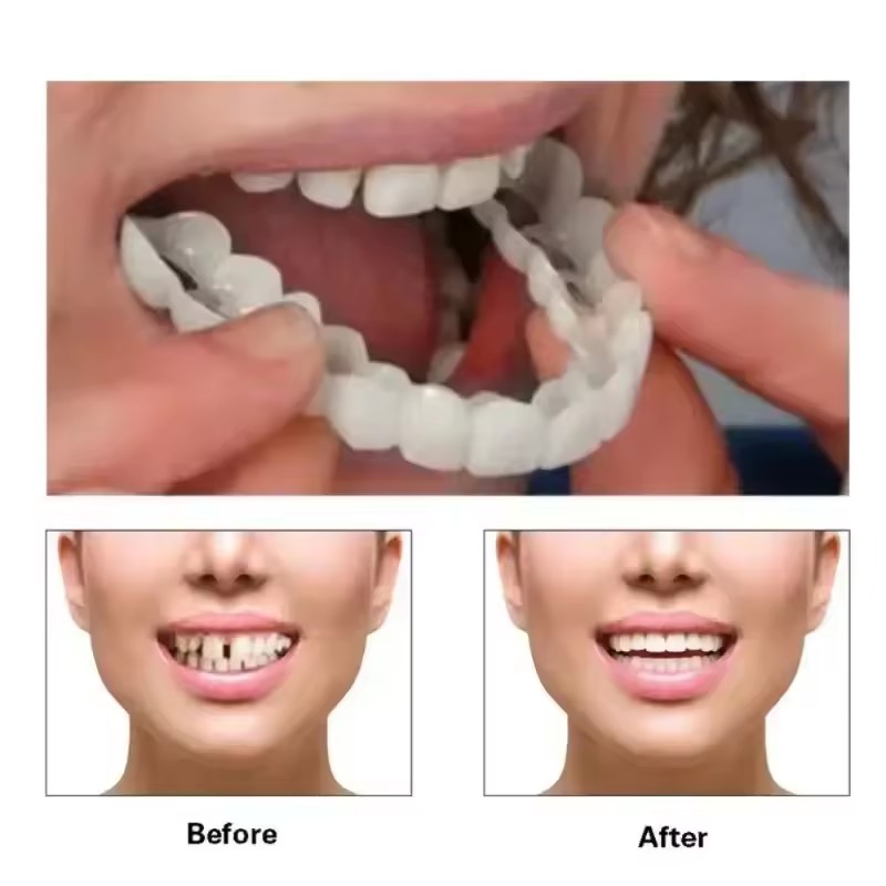 Teeth Veneers Whitening Dentur - đánh giá và giá Teeth Whitening Veneers