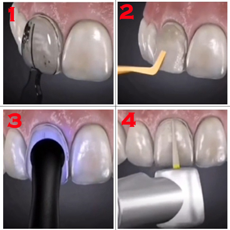 Dental Mold for Composite Resi - đánh giá và giá Teeth Whitening Veneers