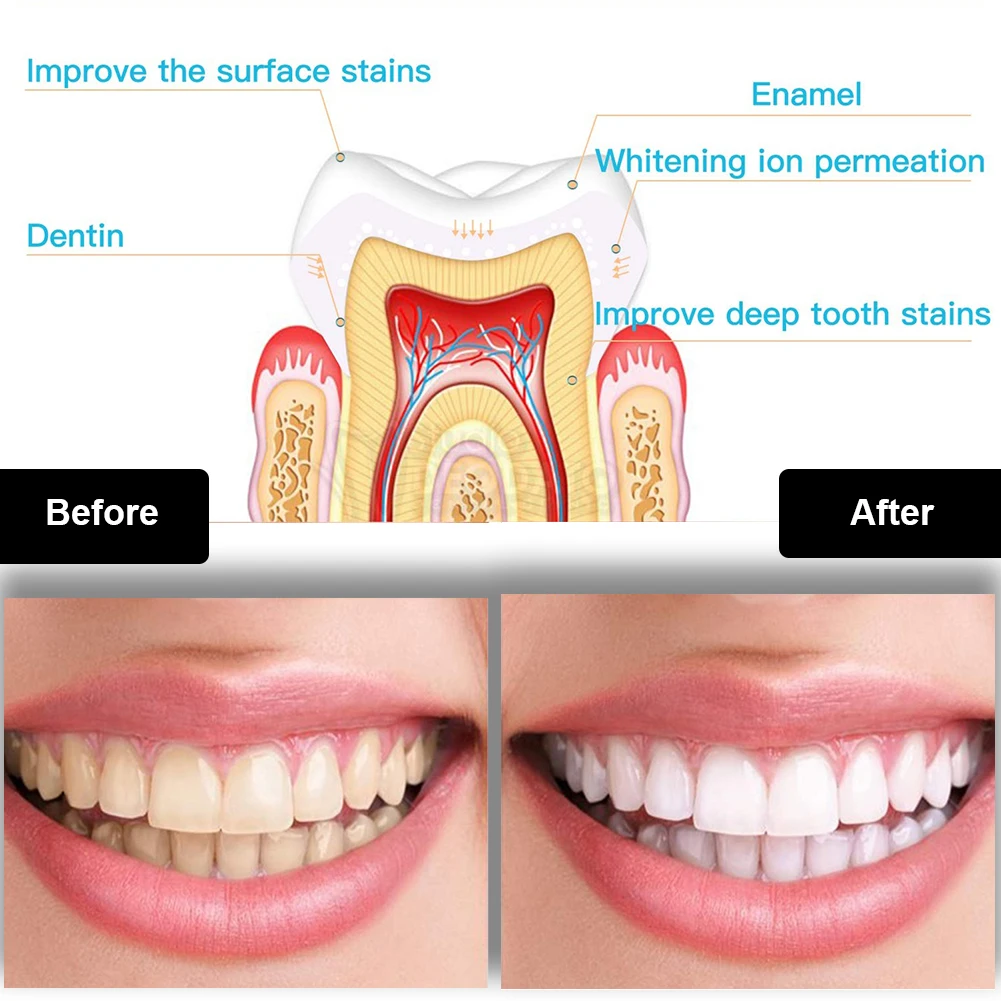 Dental Teeth Whitening Kit Min - đánh giá và giá Teeth Whitening Gels Used By Dentists